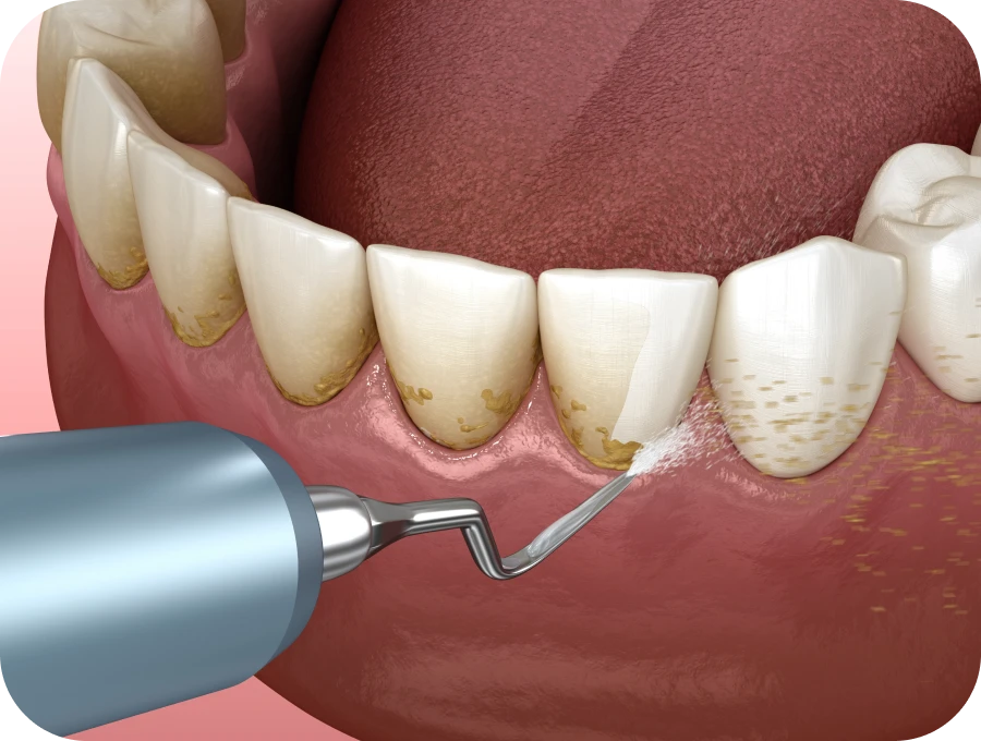 surfacage dentaire docteur sierocki