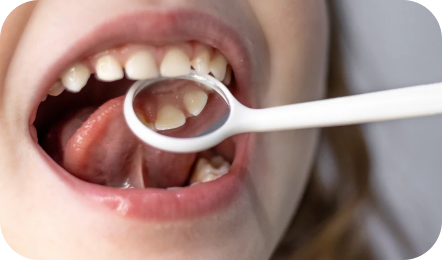 frenectomie pathologie traitement dentiste chirurgien oral sierocki