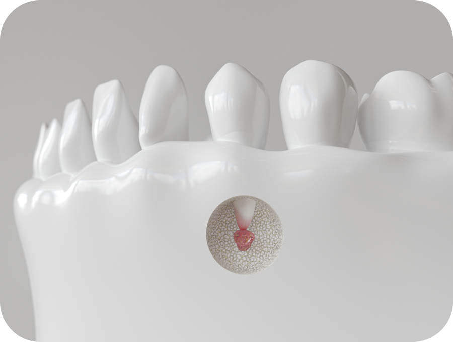 Resection apicale Dentiste Valenciennes